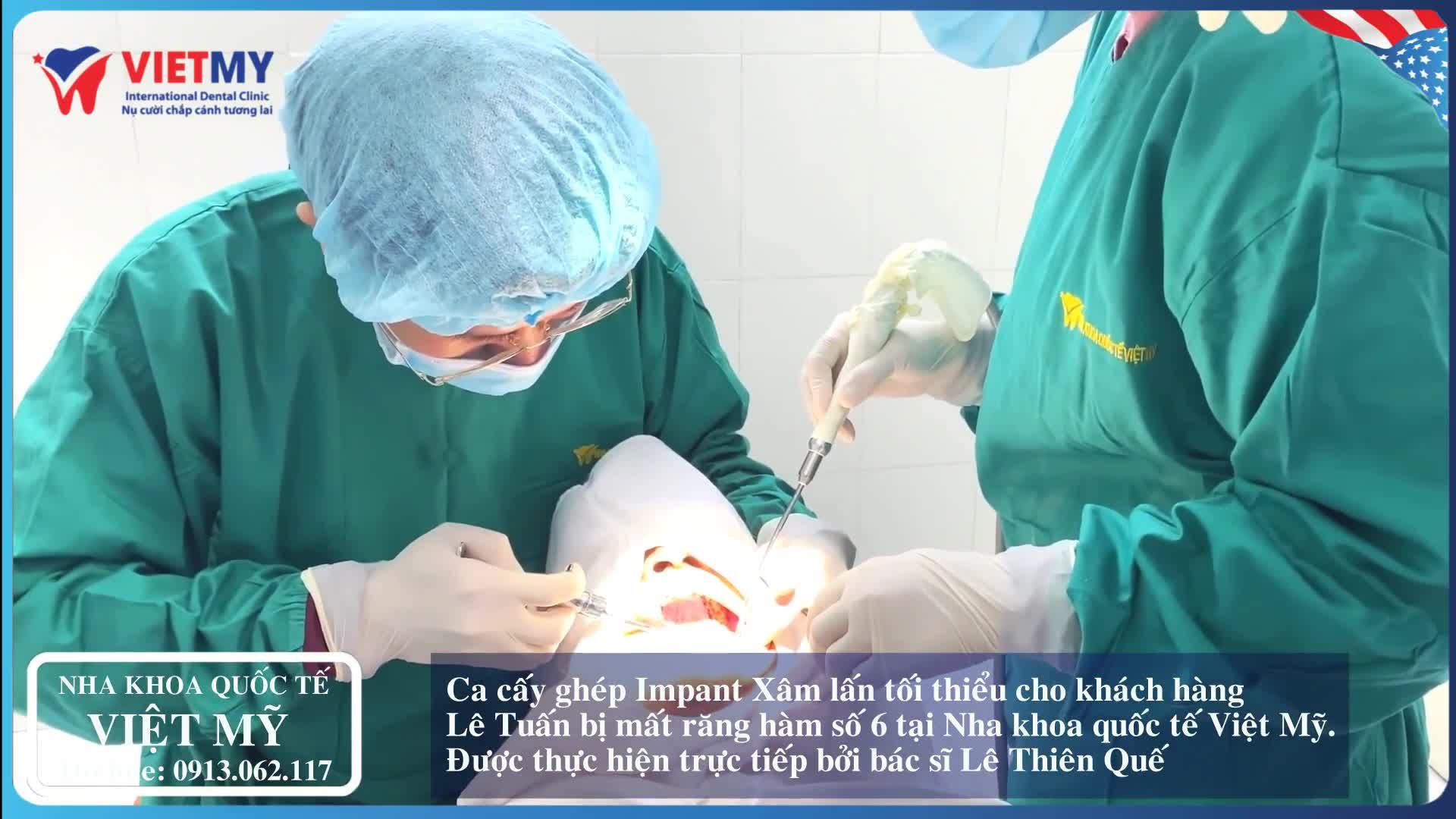 Anh Trần Lê Tuấn (1979) Hoàng Mai Hà Nội tình trạng bị mất răng số 6.