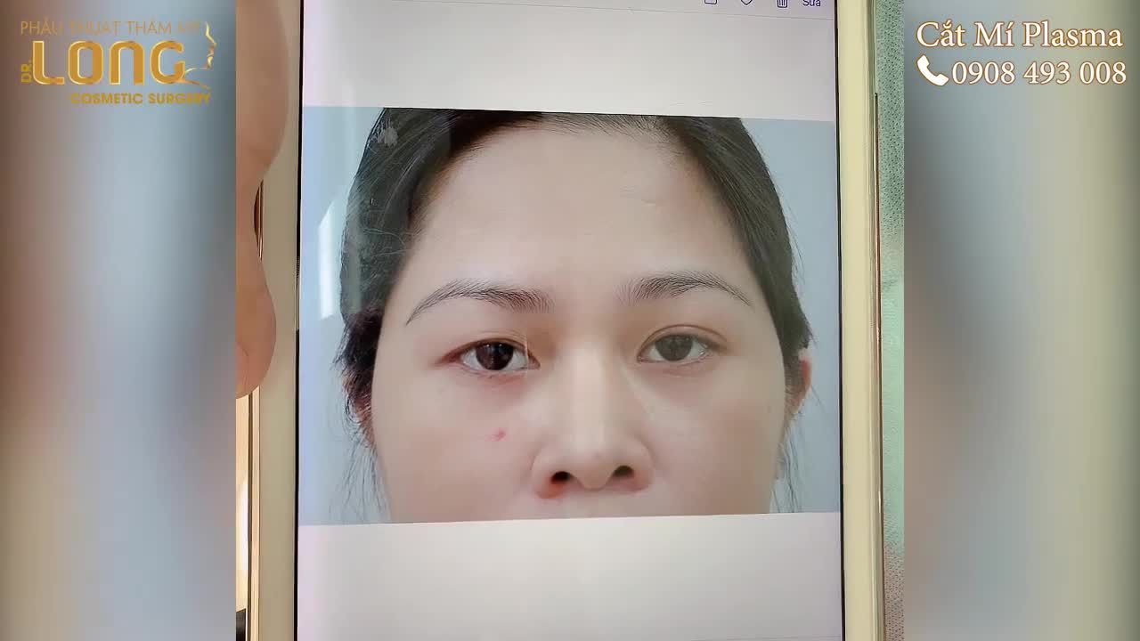 Ca cắt mí của khách hàng vừa thực hiện tại phẫu thuật thẩm mỹ Bác sĩ Long