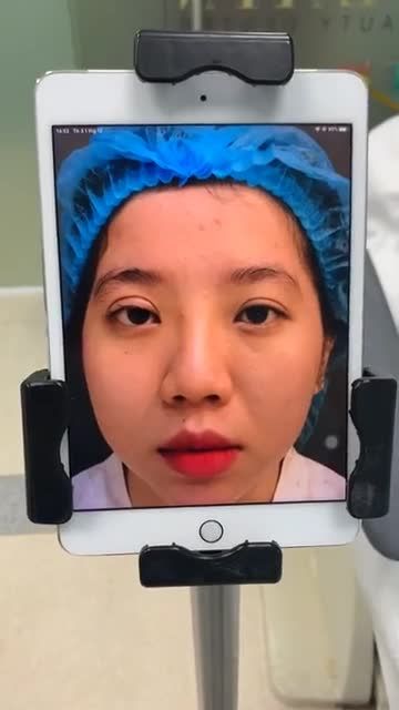 Ca Livestream của khách hàng xinh đẹp vừa làm phẫu thuật nâng mũi xong .
