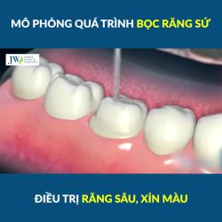 CẬN CẢNH QUÁ TRÌNH BỌC RĂNG SỨ