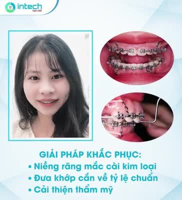 GẠT ĐI MẶC CẢM VỀ HÀM RĂNG HÔ TỰ TIN VỚI NỤ CƯỜI RẠNG RỠ