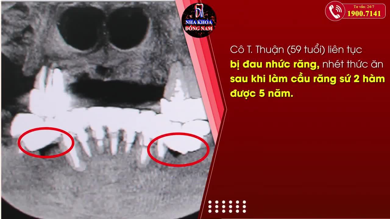 KHÁCH HÀNG CẤY GHÉP RĂNG IMPLANT THAY THẾ CẦU RĂNG SỨ HỎNG
