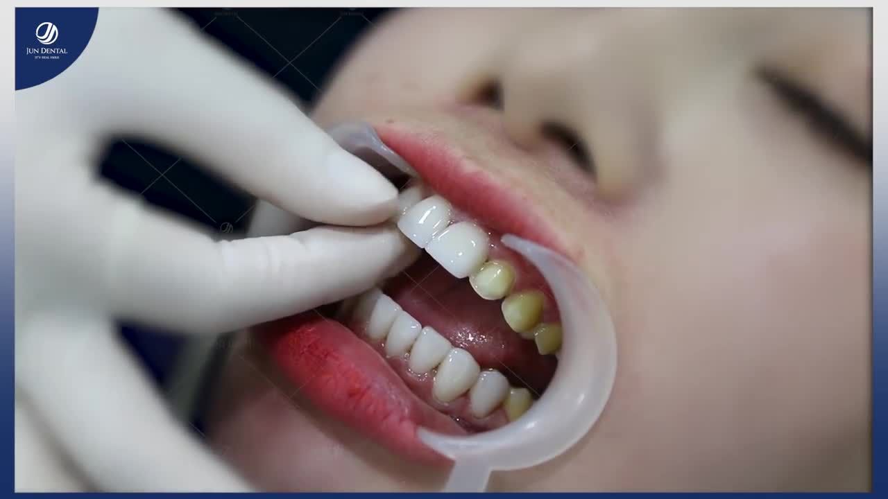 KHOÁC "LỚP ÁO MỚI" RẠNG RỠ CHO NỤ CƯỜI TỎA NẮNG