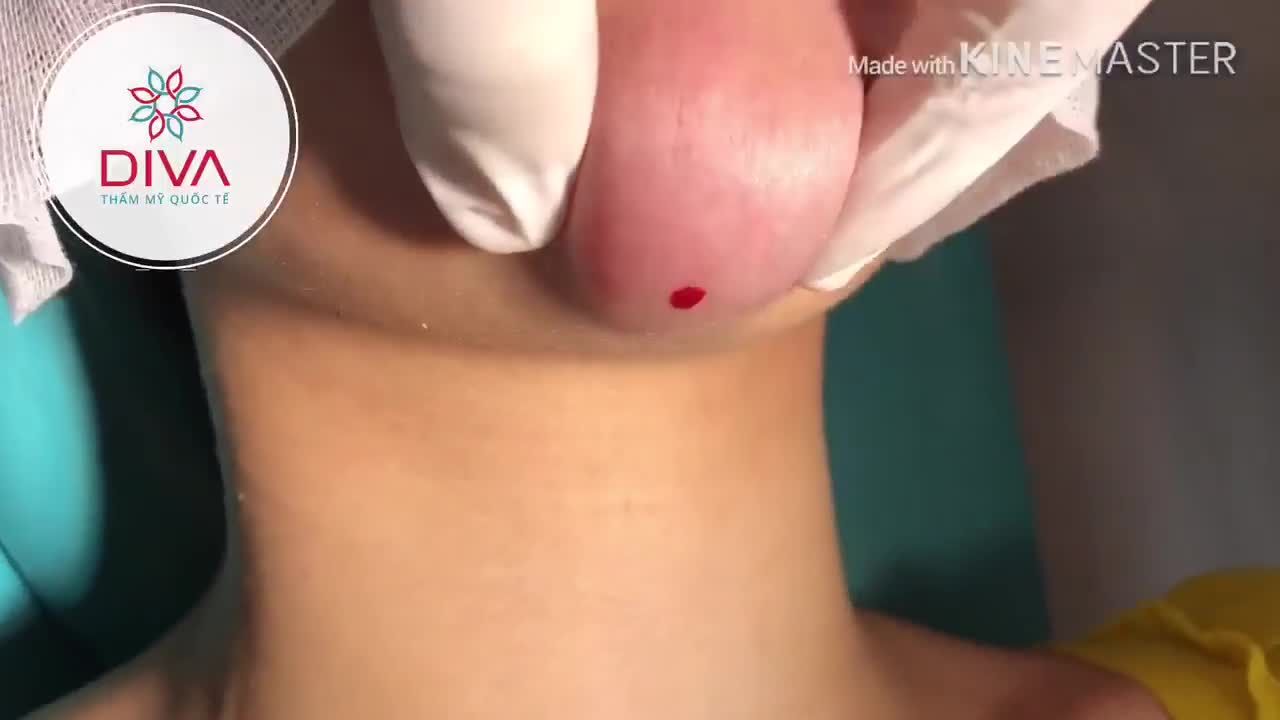 LÀM ĐẸP BẰNG FILLER CÓ TỐT KHÔNG?