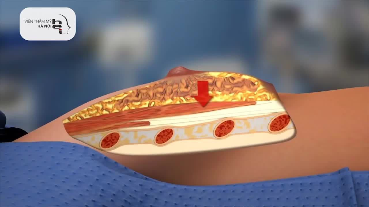 Nếu bạn đang thắc mắc quá trình nâng ngực sẽ diễn ra như thế nào thì video dưới đây sẽ mô phỏng được câu trả lời cho bạn.