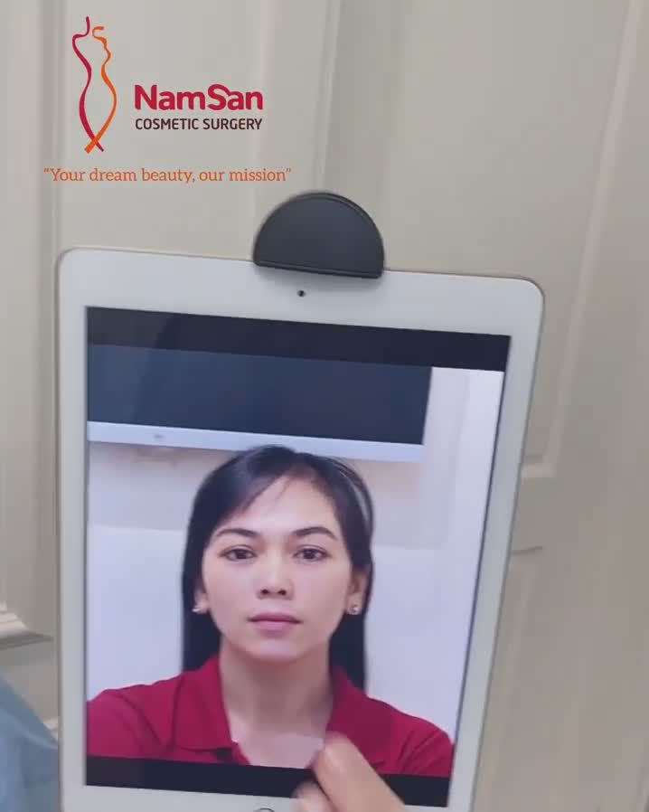 Sở hữu ngay dáng mũi đẹp tự nhiên chỉ sau 60p phẫu thuật tại Thẩm mỹ NamSan-Ths.Bs Nguyễn Hùng Thế.