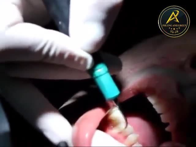 Tẩy trắng răng được thực hiện như thế nào?