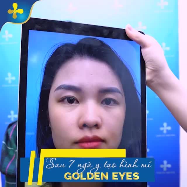 Từ đôi mắt với nếp mí rất nhỏ, thiếu tính thẩm mỹ giờ đây đã trở thành mắt 2 mí xinh tươi, to tròn, rõ nét.