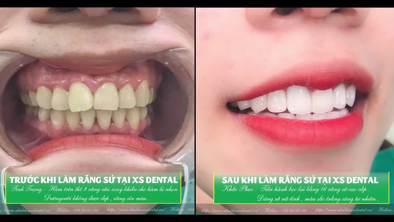 Video cảm nhận của khách hàng khi hoàn thành trọn bộ thẩm mỹ 16 răng sứ cao cấp tại Xs .