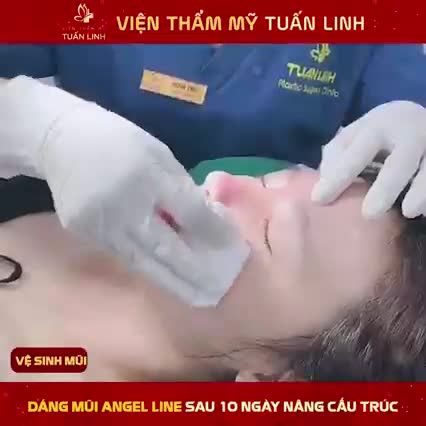 CẬN CẢNH DÁNG MŨI ANGEL LINE SAU 10 NGÀY NÂNG CẤU TRÚC TẠI TUẤN LINH