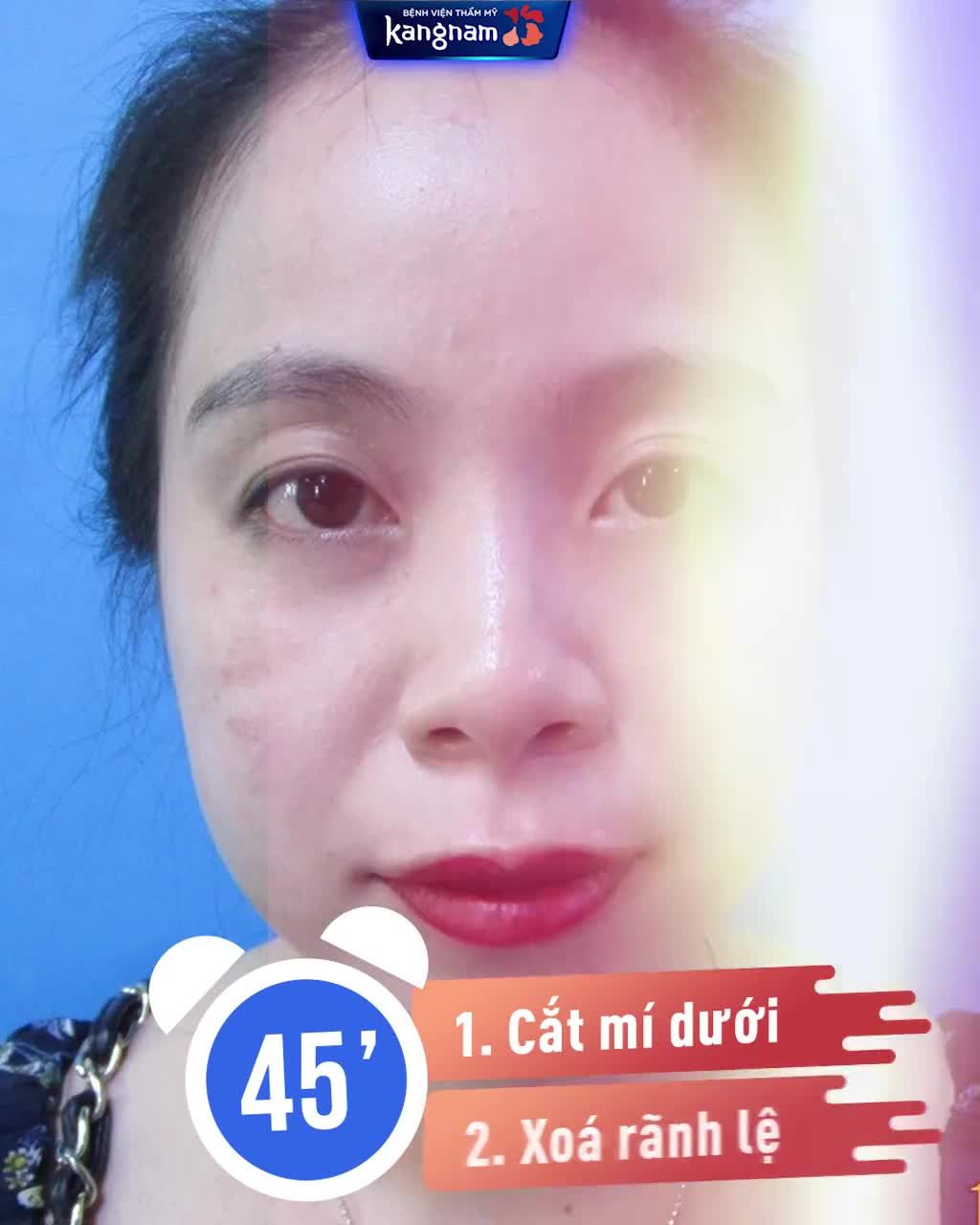 Công nghệ Perfect Eyes: Đánh bay Mí chùng Bọng mỡ  Rãnh lệ