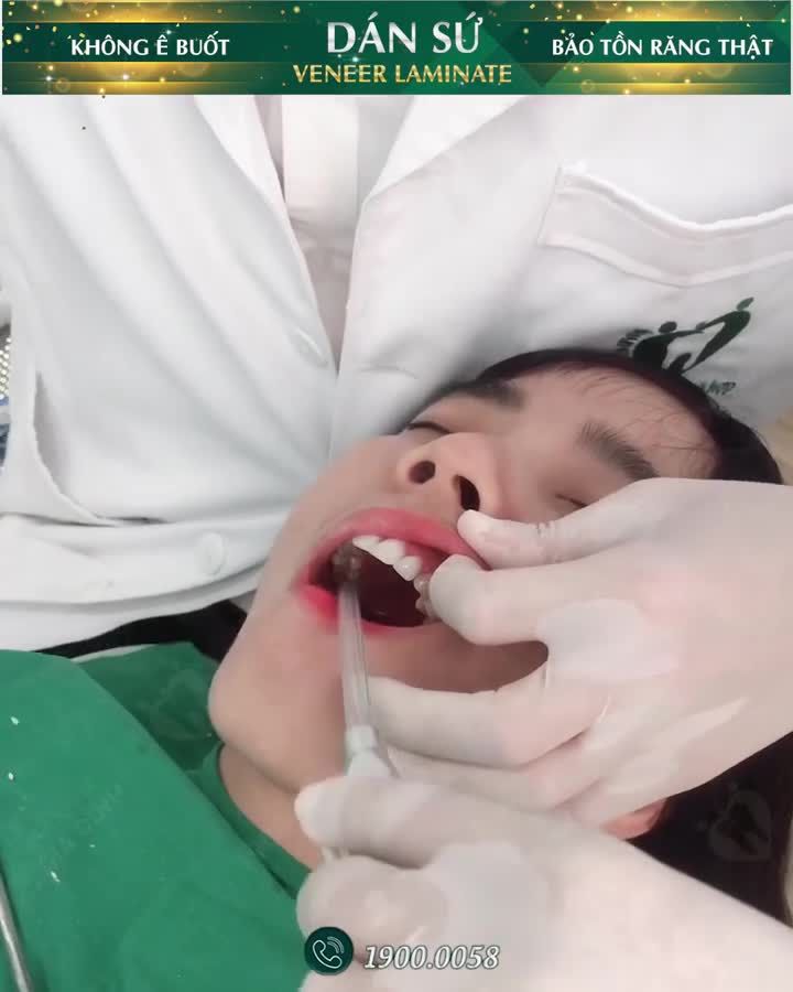 Giải pháp Dán sứ Veneer AN TOÀN đặt lên hàng đầu tại Nha khoa Gia Đình