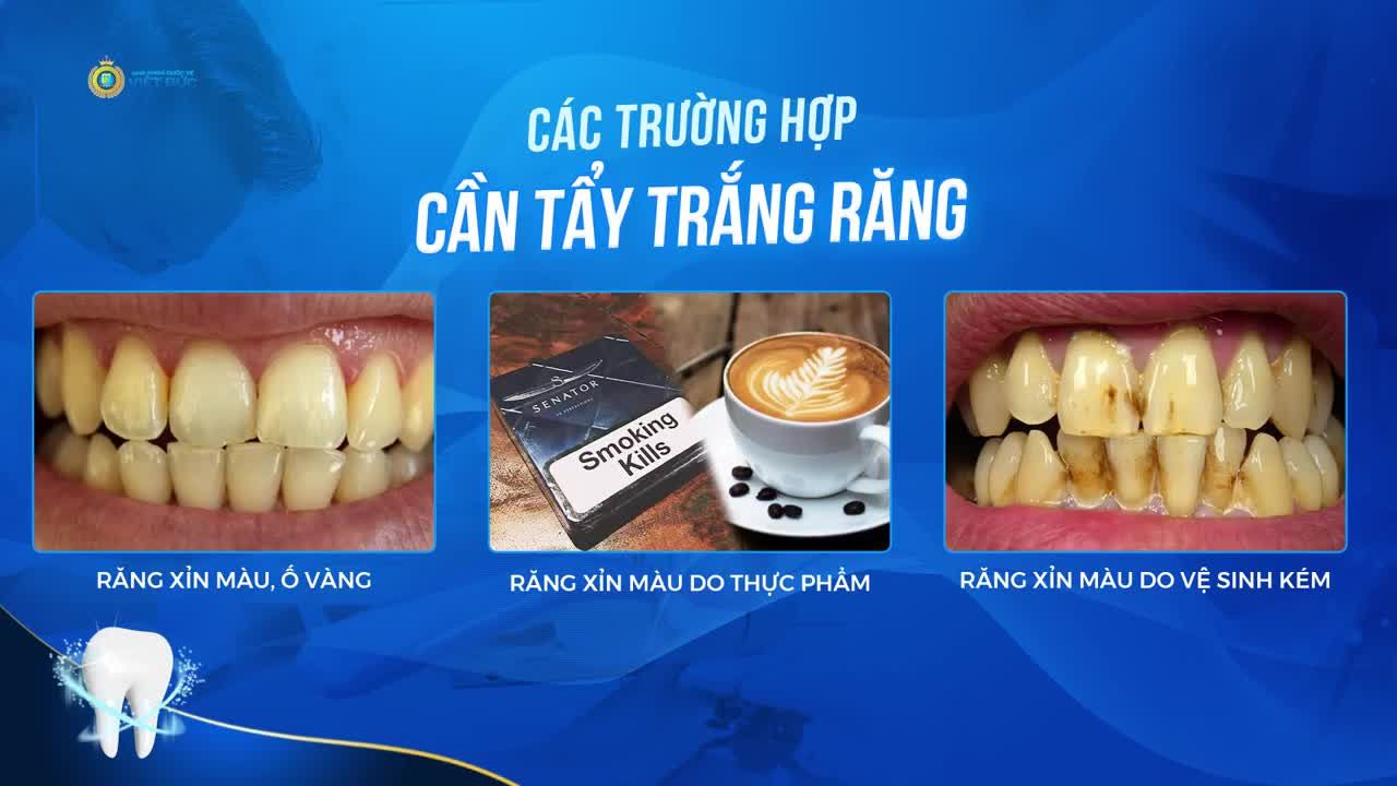 ƯU ĐÃI 15% TẨY TRẮNG LASER WHITENING, ĐỪNG BỎ LỠ BẠN ƠI!