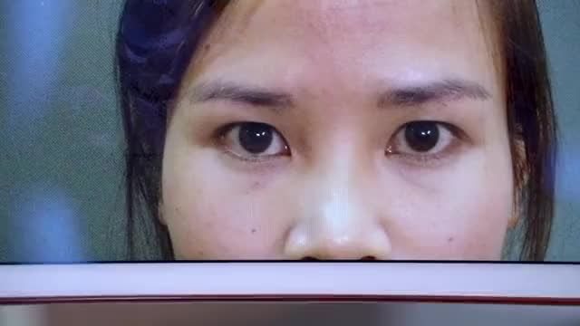 Mí đẹp tự nhiên ngay sau khi thực hiện tiểu phẫu và ổn định sau 7 ngày cắt chỉ