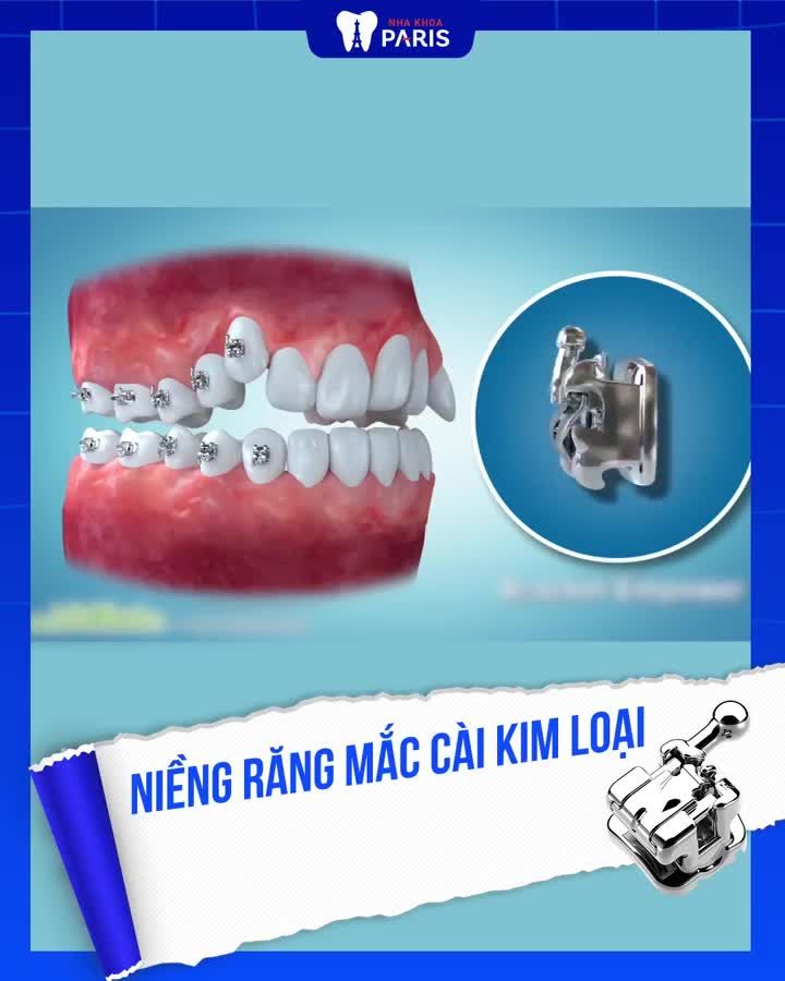 Niềng răng: Chọn TỐC ĐỘ hay THẨM MỸ?