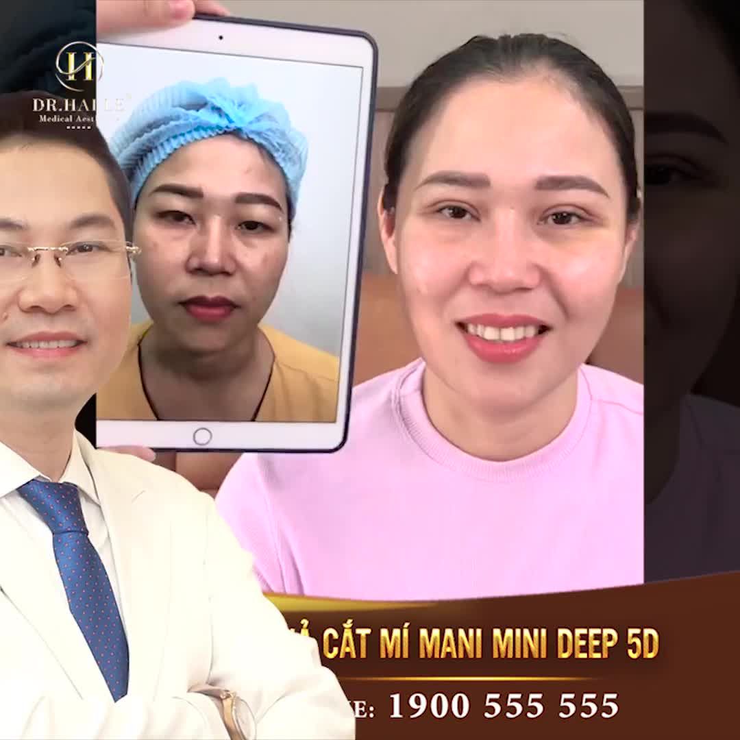 Rút ngắn 50% thời gian lành, chị khách hàng hạnh phúc rạng rỡ chỉ sau 7 ngày thẩm mỹ mà không hề sưng tím hay lộ dấu hiệu cắt mí.