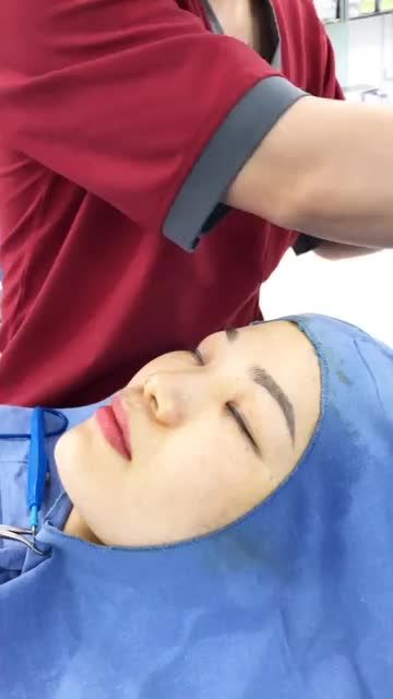 Nếp mí nhỏ Da thừa mắt nhiều