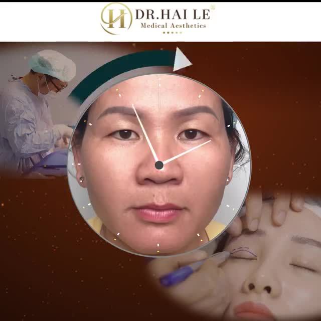 Chào buổi sáng đầu tuần với những ca mí siêu khó nhưng kết quả siêu đẹp.