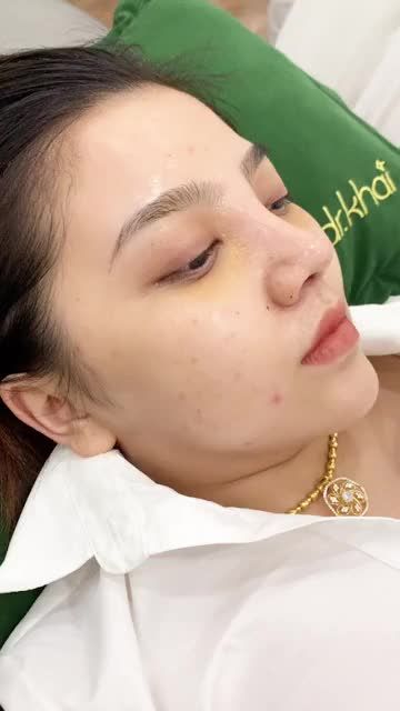 GIẢI PHÁP DÀNH CHO CHIẾC MŨI THẤP SÓNG ĐẦU MŨI NGẮN