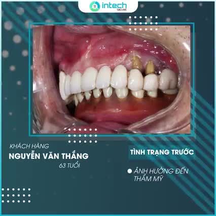 LOẠI BỎ LO LẮNG NỖI ĐAU TRỒNG RĂNG IMPLANT BẰNG CÁCH NÀO?