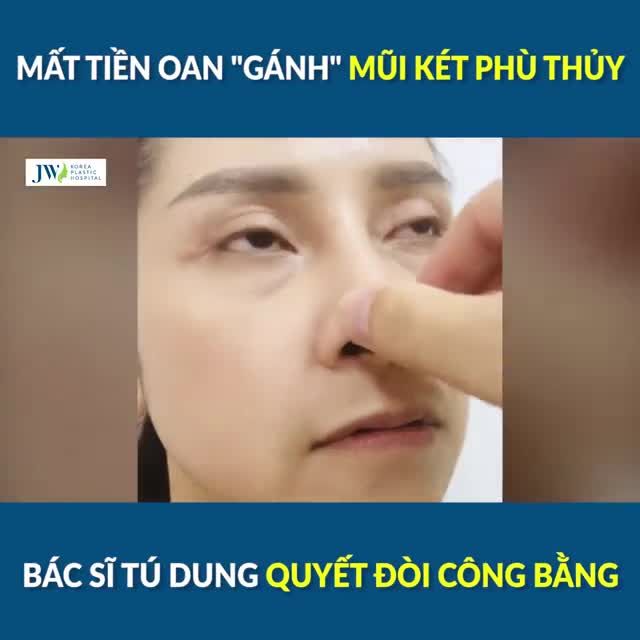 Mất tiền oan gánh MŨI KÉT PHÙ THỦY, Bác sĩ TÚ DUNG Nâng mũi cấu trúc QUYẾT ĐÒI CÔNG BẰNG