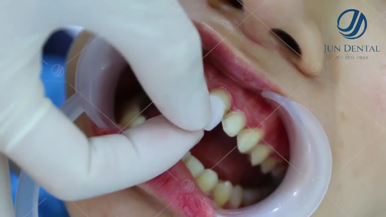 MỤC SỞ THỊ QUY TRÌNH THẨM MỸ RĂNG SỨ CÔNG NGHỆ CHUYỂN GIAO ĐỘC QUYỀN TỪ HÀN QUỐC