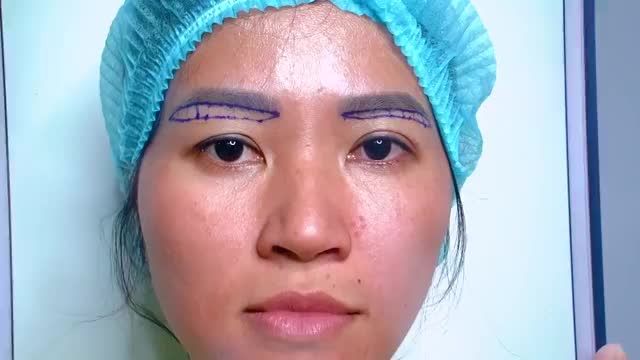Trẻ hóa đôi mắt kịp đón Noel và năm mới 2021 với phương pháp Nâng cung mày tại Dr.Hải Lê chi nhánh HCM