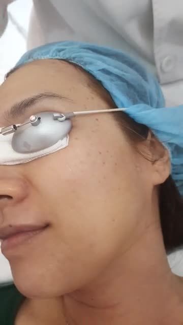 MỤN THỊT dai dẳng bị XOÁ BAY chỉ sau 30 phút!