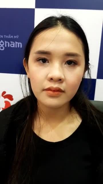 Mí lệch Đuôi mắt sụp Mắt buồn