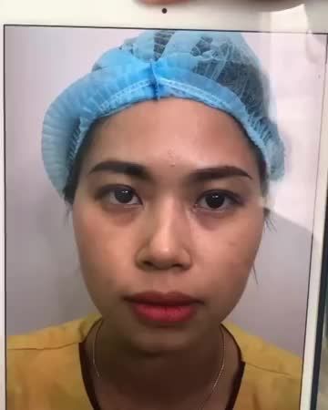 Bác sĩ quay cận cảnh cho cả nhà xem kết quả Cắt mí sau 7 ngày đẹp ngoài sự mong đợi tại chi nhánh TP.HCM