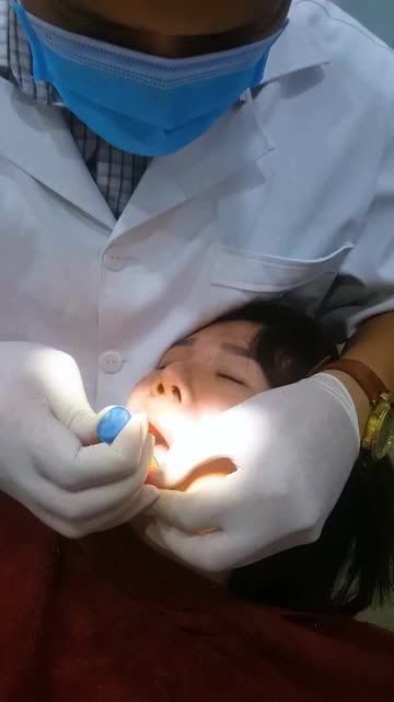DÁN SỨ VENEER 16 RĂNG CHO KH HỨA THU LỆ