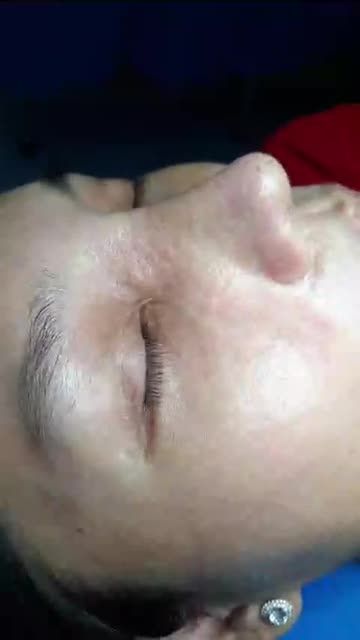 KHÁCH HÀNG TÁI KHÁM SAU 8 NGÀY NÂNG MŨI NHÀ BS KỲ