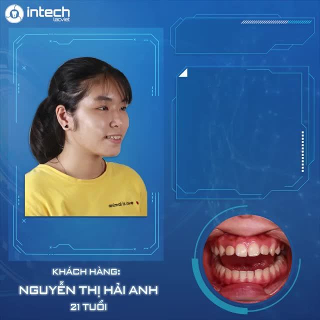 MÀN THAY ĐỔI NHAN SẮC BẤT NGỜ SAU KHI NIỀNG RĂNG HÔ