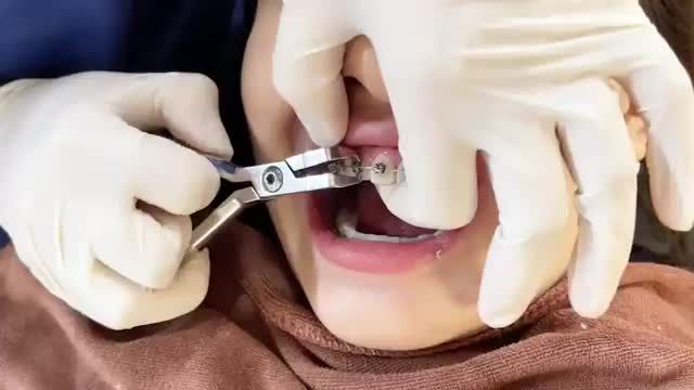 Tháo mắc cài cho bệnh nhân răng KHẤP KHỂNH