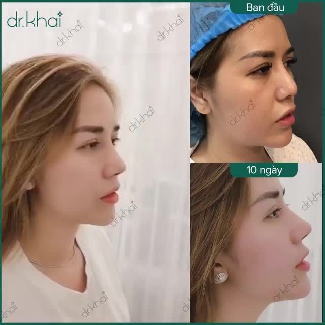 THỜI GIAN TỪ GIỜ TỚI TẾT LÀ THỜI ĐIỂM VÀNG ĐỂ MŨI ỔN ĐỊNH VÀ ĐẸP