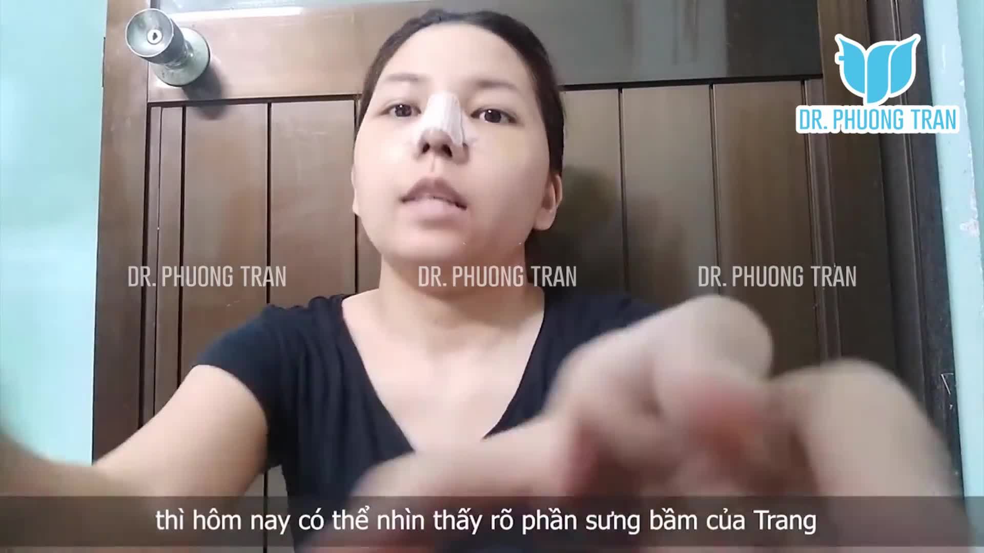 Tự tháo băng sụn sườn tại nhà có phức tạp?