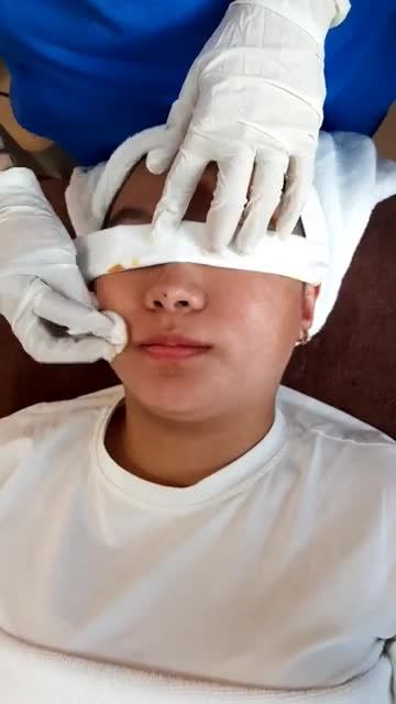 Da đẹp đón Tết với công nghệ trị mụn tận gốc De Acne