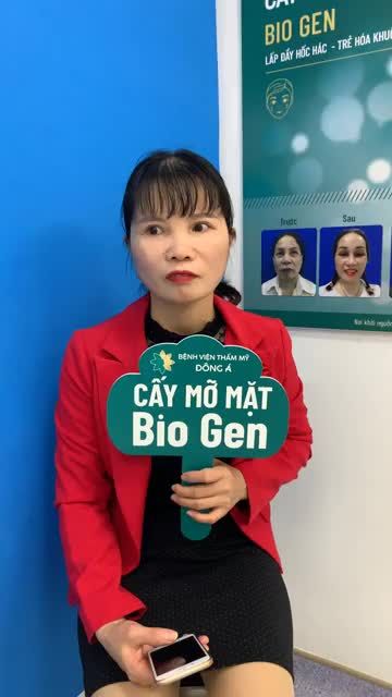 Kết quả cấy mỡ mặt Bio Gen, khách hàng hài lòng cười tít mắt cùng đón xem
