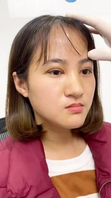 Sụp mí bẩm sinh Mắt u buồn Tầm nhìn hạn chế