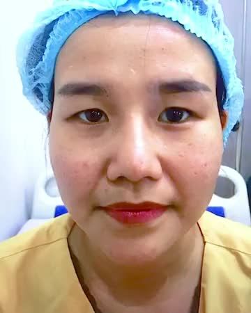 Mí đẹp sau 7 ngày thực hiện bạn có tin? Nếu chưa tin bạn theo dõi video này nhé
