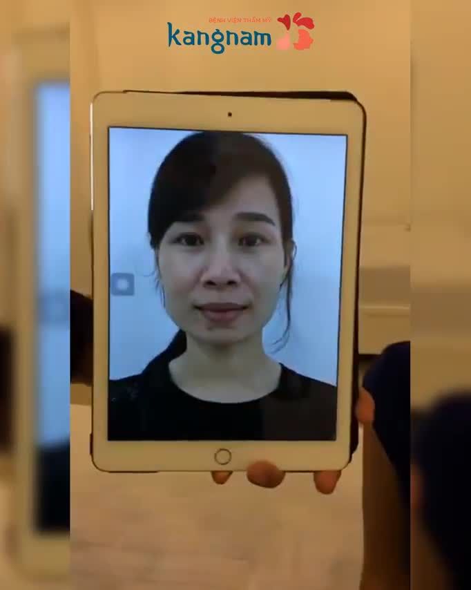 Điểm 10 cho màn "lột xác" sau phẫu thuật Gọt Hàm