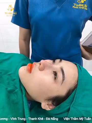 Khách hàng Nâng mũi cấu trúc