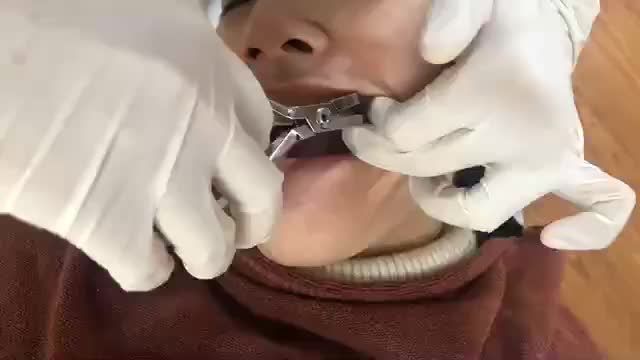 THÁO MẮC CÀI cho bệnh nhân răng THƯA CHÌA