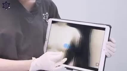 VÒNG 1 KHIÊM TỐN TĂNG SIZE "THẦN TỐC" SAU KHI ĐẶT TÚI NGỰC SIZE PHÙ HỢP NHẤT