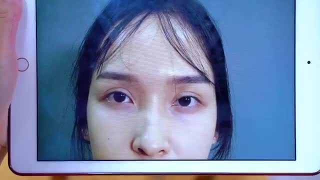 Bác sĩ làm việc xuyên trưa GIẢI CỨU thành công ca mí lỗi hỏng do khách hàng "chót dại" thực hiện tại spa cỏ dẫn đến biến chứng