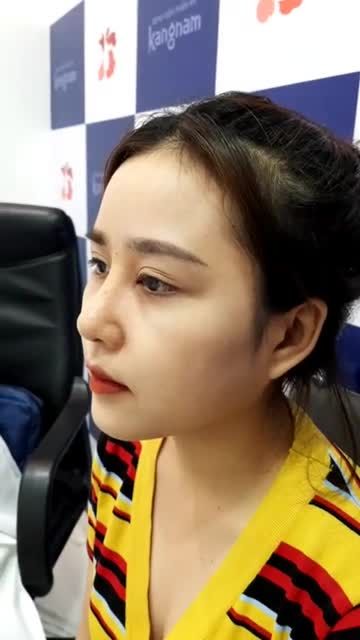Siêu phẩm nâng mũi Sline sau 10 ngày đây ạ!