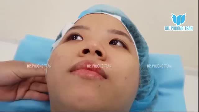 NÂNG MŨI CẤU TRÚC KẾT HỢP ĐỘN CẰM