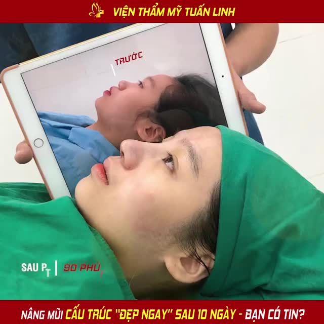 XEM ĐẾN CUỐI CLIP ĐỂ THẤY DÁNG MŨI CẤU TRÚC SAU 10 NGÀY SẼ NHƯ THẾ NÀO... !