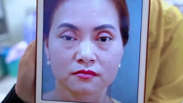 Dr.Hải Lê giải cứu kịp thời ca mí lỗi hỏng nặng ĐỨT CƠ NÂNG MI 2 bên sau khi thực hiện cắt mí tại cơ sở không phép