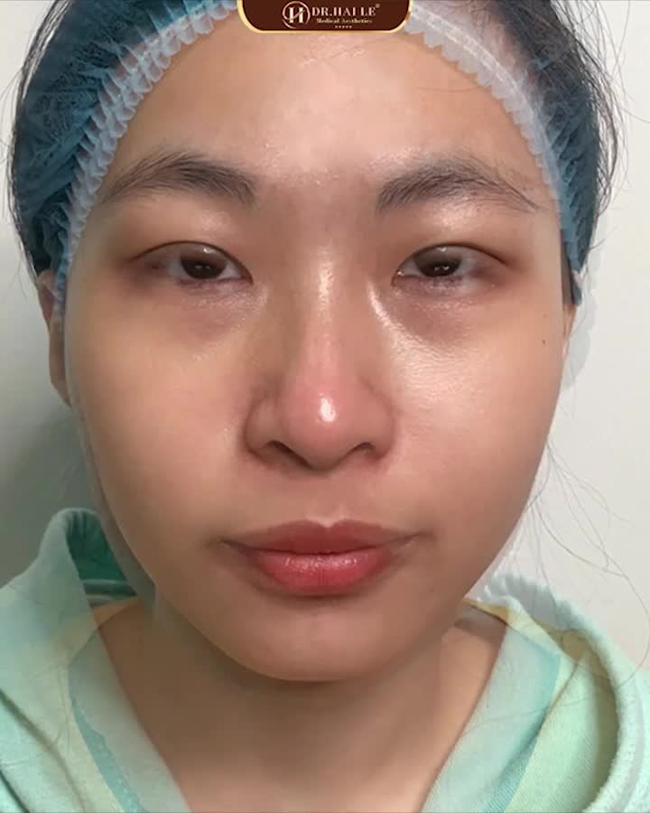 KẾT QUẢ CẮT MÍ KHÓ MK TẠI DR HẢI LÊ
